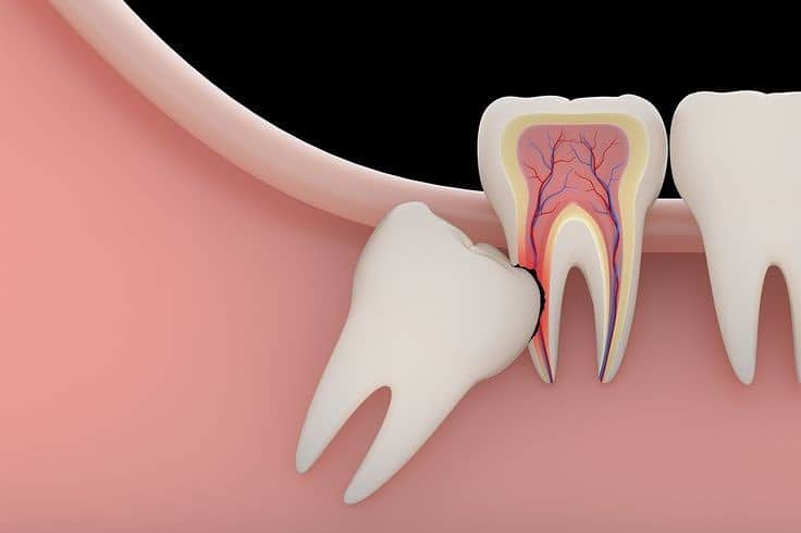 Wisdom Tooth extraction pain