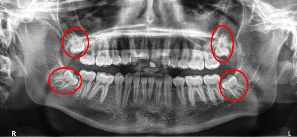 Cost Of Wisdom Tooth Extraction Bangalore