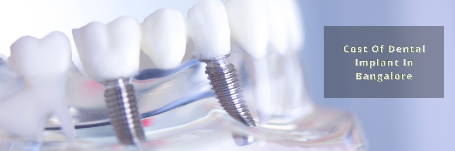 Cost Of Dental Implant In Bangalore