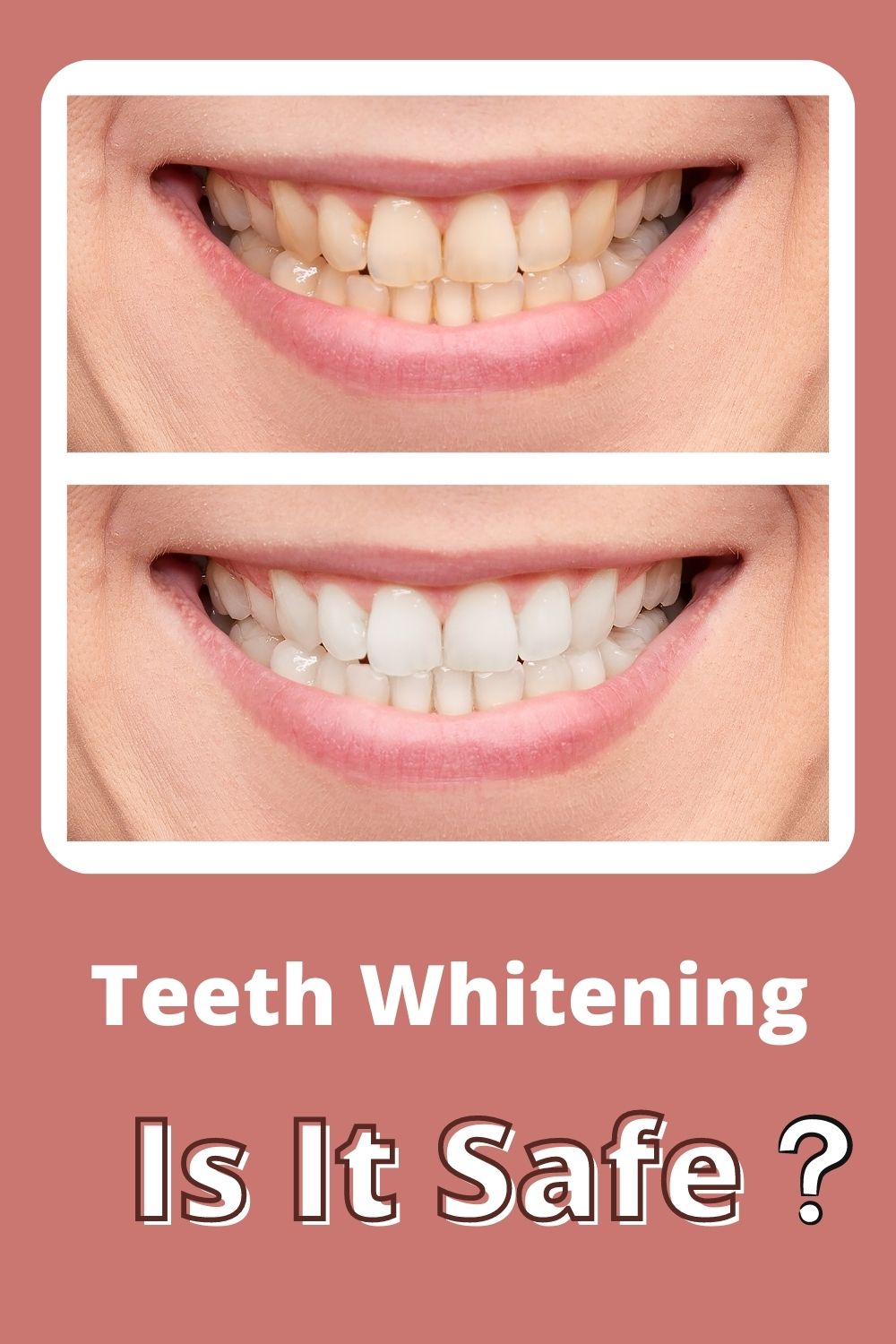 Teeth Whitening Is It Safe