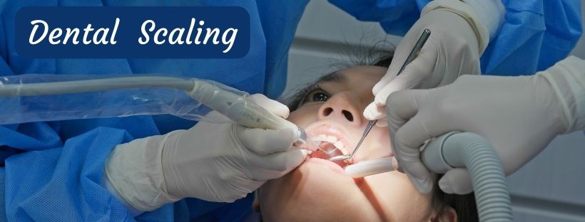 dental scaling