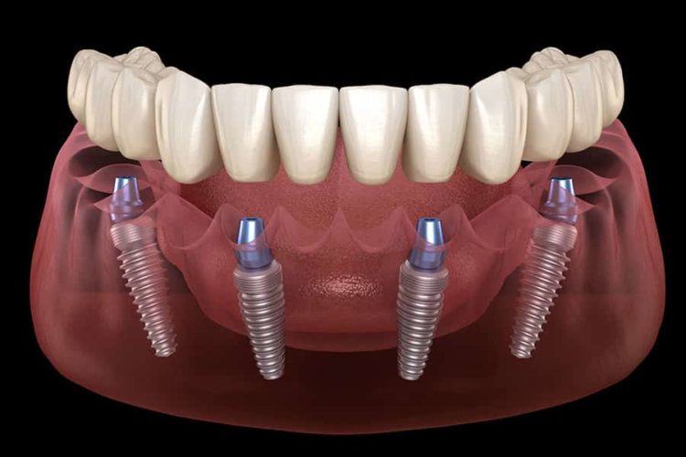 All-on-4-Dental-Implants