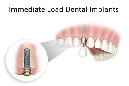 Immediate-Load-Dental-Implants