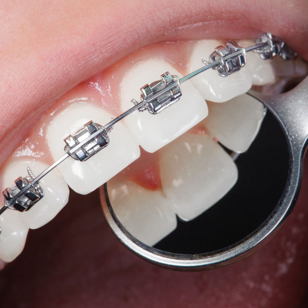 Orthodontic Treatment Types and Cost