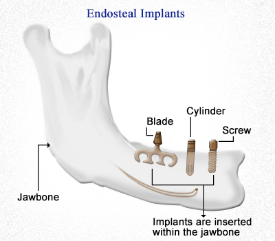 endosteal implants